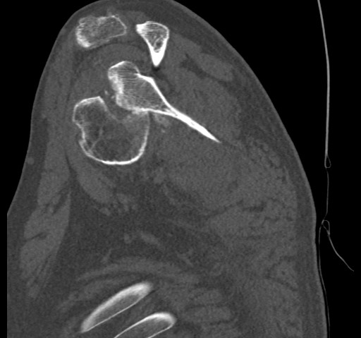 Anterior glenohumeral dislocation with Hill-Sachs lesion (Radiopaedia 62877-71249 Sagittal bone window 32).jpg