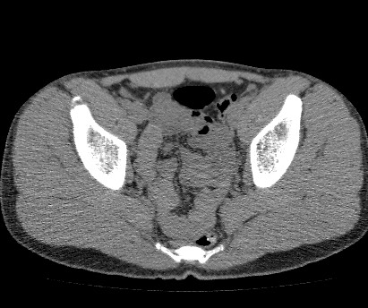 Anterior inferior iliac spine avulsion fracture (Radiopaedia 81312-94999 Axial non-contrast 45).jpg