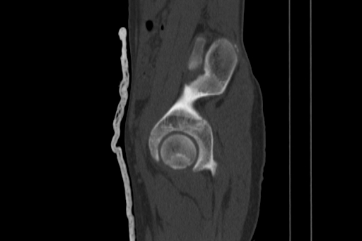 Anterior inferior iliac spine avulsion injury (Radiopaedia 88666-105376 Sagittal bone window 32).jpg