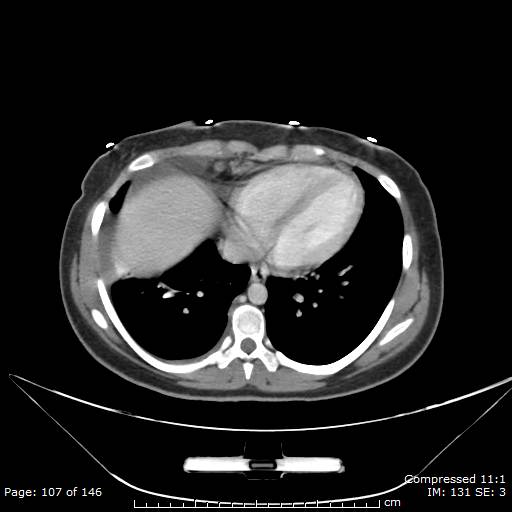 Anterior mediastinal B cell Lymphoma (Radiopaedia 50677-56114 A 54).jpg