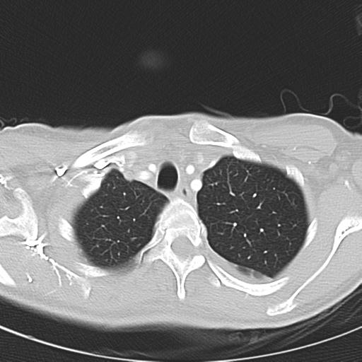 Anterior mediastinal lymphoma (Radiopaedia 29556-30061 Axial lung window 9).jpg