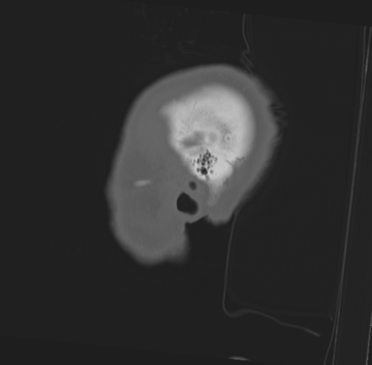 Anterior nasal spine fracture (Radiopaedia 46138-50494 Sagittal bone window 7).png