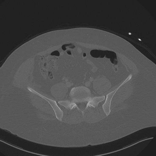 Anterior superior iliac spine avulsion fracture (Radiopaedia 44541-48244 Axial bone window 71).png