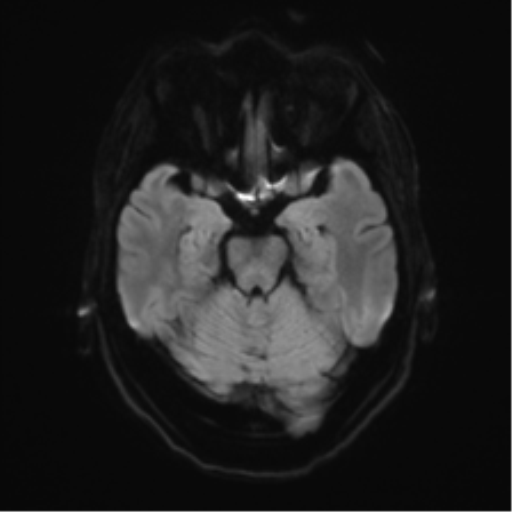 Anterior temporal pole cysts (Radiopaedia 46629-51102 Axial DWI 37).png