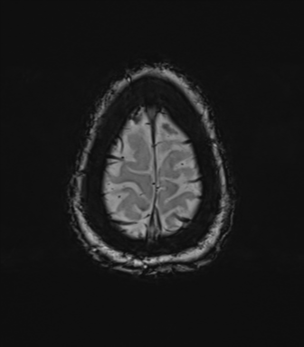 Anterior temporal pole cysts (Radiopaedia 46629-51102 Axial SWI 81).png