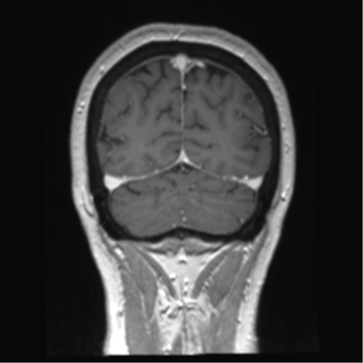 Anterior temporal pole cysts (Radiopaedia 46629-51102 Coronal T1 C+ 35).png