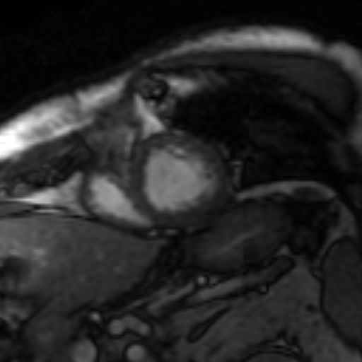 File:Anteroseptal hypokinesia after myocardial infarction (Radiopaedia 15978-15633 Short axis SSFE 18).jpg