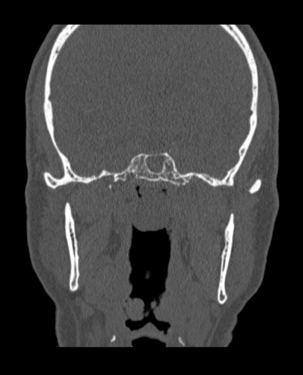 Antrochoanal polyp (Radiopaedia 79011-92169 Coronal bone window 11).jpg