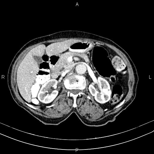 File:Aortic aneurysm and Lemmel syndrome (Radiopaedia 86499-102554 A 32).jpg