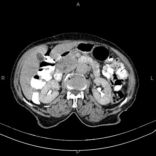 File:Aortic aneurysm and Lemmel syndrome (Radiopaedia 86499-102554 Axial C+ delayed 32).jpg