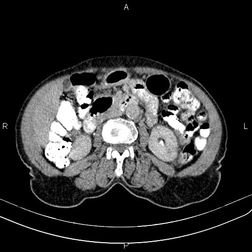 Aortic aneurysm and Lemmel syndrome (Radiopaedia 86499-102554 Axial C+ delayed 38).jpg