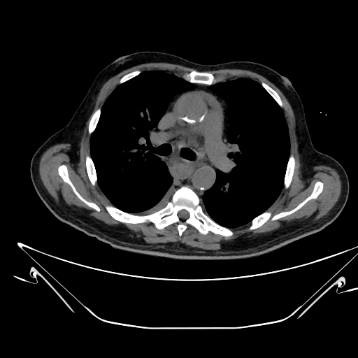 Aortic arch aneurysm (Radiopaedia 84109-99365 Axial non-contrast 119).jpg