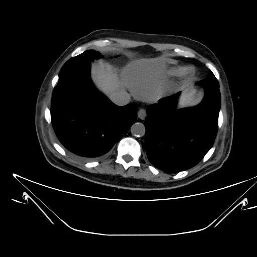 Aortic arch aneurysm (Radiopaedia 84109-99365 Axial non-contrast 226).jpg