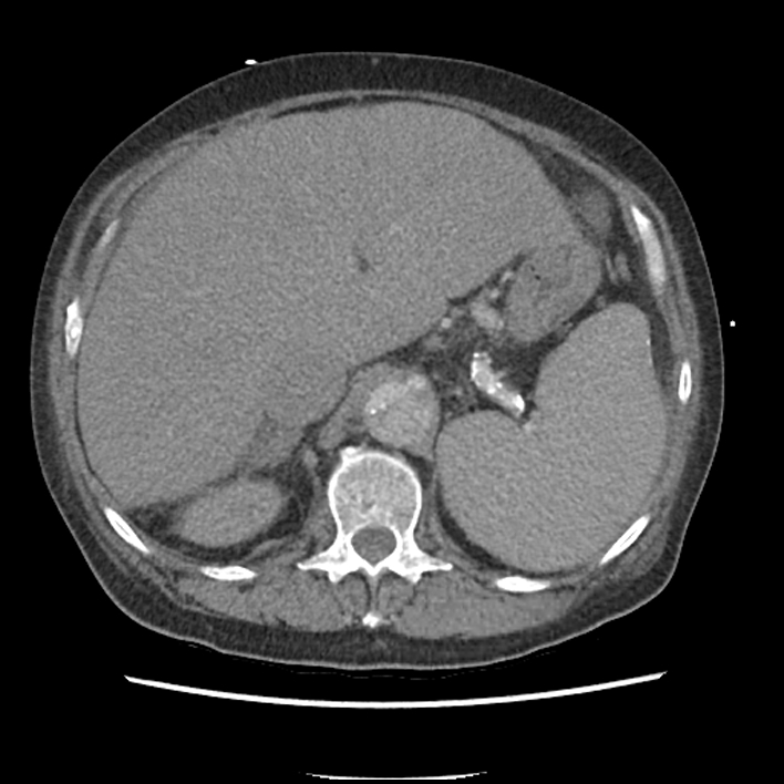 Aortic arch graft infection (FDG PET-CT) (Radiopaedia 71975-82437 A 63).jpg