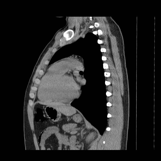 File:Aortic arch stent (Radiopaedia 30030-30595 B 19).jpg
