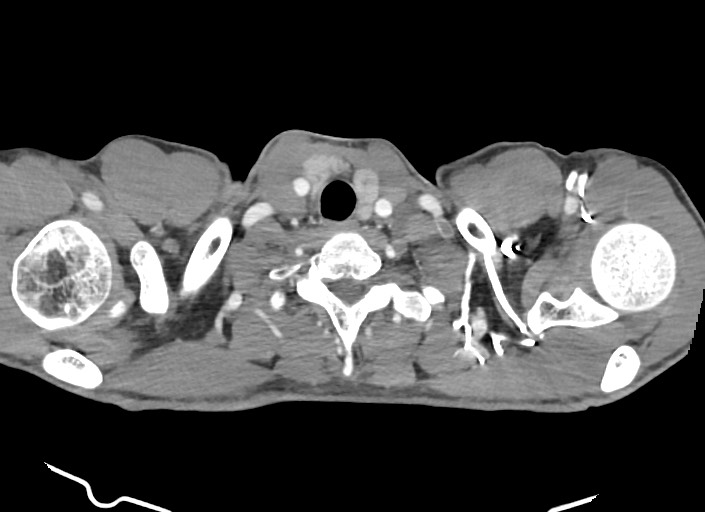 File:Aortic coarctation with aneurysm (Radiopaedia 74818-85828 A 186).jpg