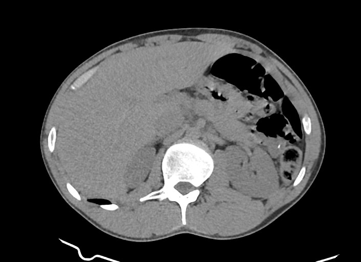 File:Aortic coarctation with aneurysm (Radiopaedia 74818-85828 A 19).jpg