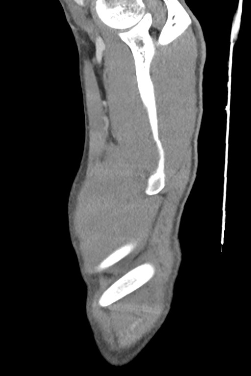 Aortic coarctation with aneurysm (Radiopaedia 74818-85828 B 13).jpg