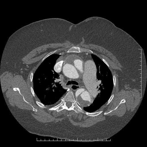 Aortic dissection- Stanford A (Radiopaedia 35729-37268 A 26).jpg