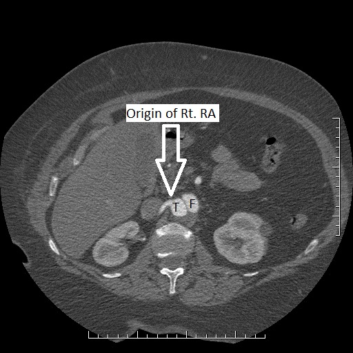 File:Aortic dissection- Stanford A (Radiopaedia 35729-39076 Multiple Annotated 6).jpg