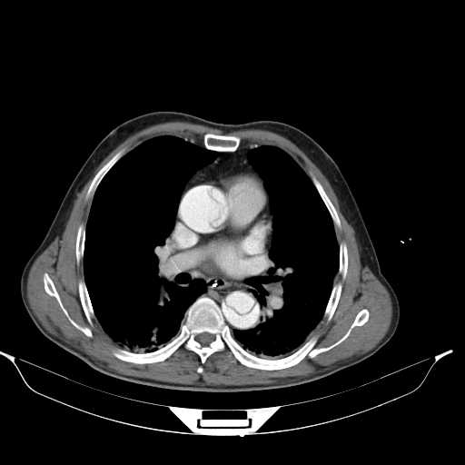 Aortic dissection- Stanford type A (Radiopaedia 22085-22085 A 22).jpg
