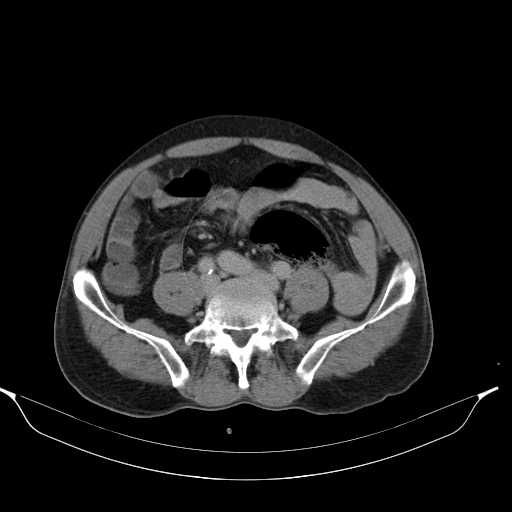 File:Aortic dissection- Stanford type A (Radiopaedia 22085-22085 Axial C+ delayed 36).jpg