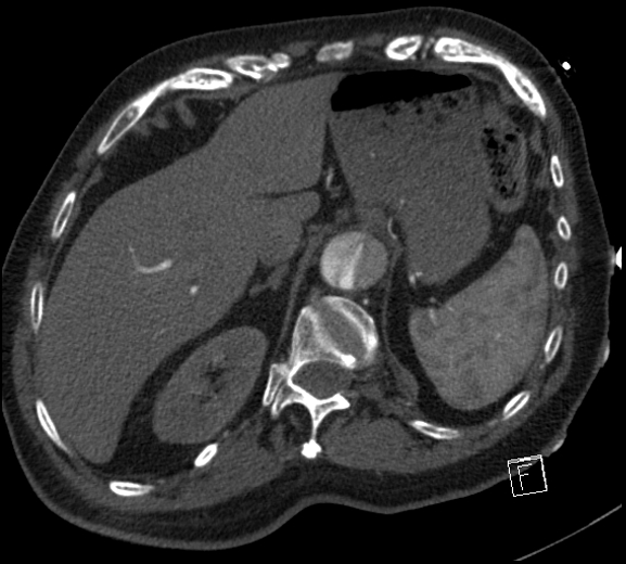 Aortic dissection (CTPA) (Radiopaedia 75506-86750 A 87).jpg