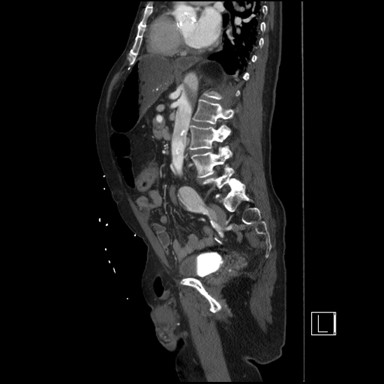 Aortic dissection (CTPA) (Radiopaedia 75506-86750 G 65).jpg