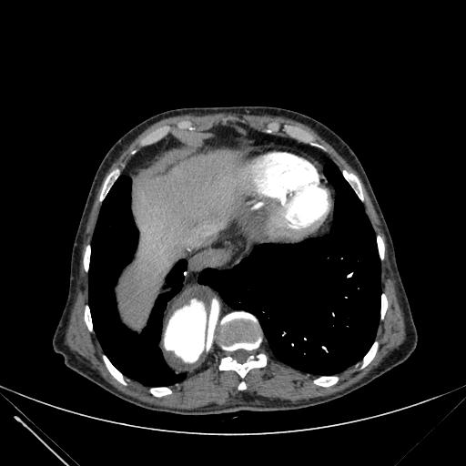 Aortic dissection (Radiopaedia 27466-27665 C+ arterial phase 234).jpg