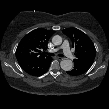 File:Aortic dissection (Radiopaedia 57969-64959 A 130).jpg