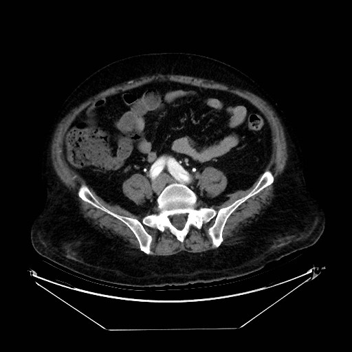 Aortic dissection (Radiopaedia 62562-71000 A 85).jpg