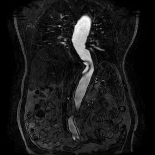 Aortic dissection - Stanford A - DeBakey I (Radiopaedia 23469-23551 D 141).jpg