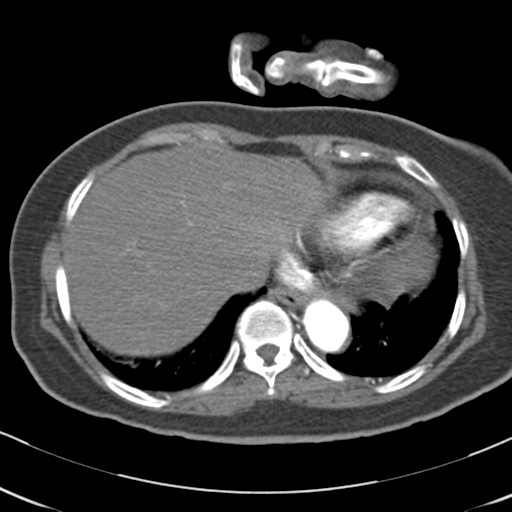 File:Aortic dissection - Stanford type A (Radiopaedia 39073-41259 A 64).png