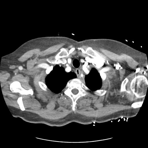 Aortic dissection - Stanford type B (Radiopaedia 50171-55512 A 6).png