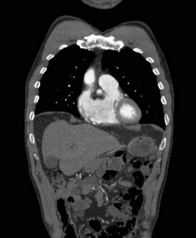 File:Aortic dissection - Stanford type B (Radiopaedia 73648-84437 B 33).jpg