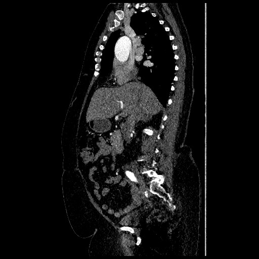 File:Aortic dissection - Stanford type B (Radiopaedia 88281-104910 C 30).jpg