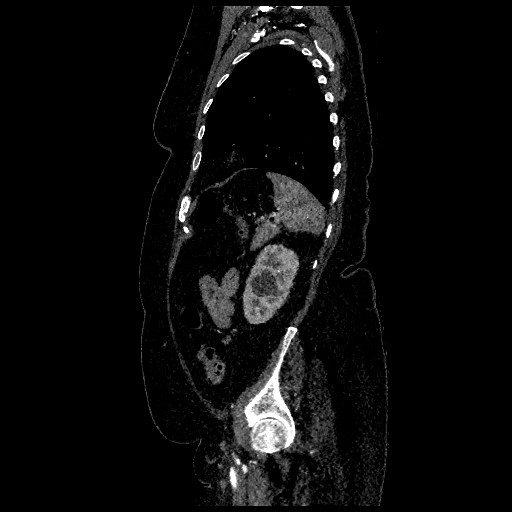 File:Aortic dissection - Stanford type B (Radiopaedia 88281-104910 C 70).jpg