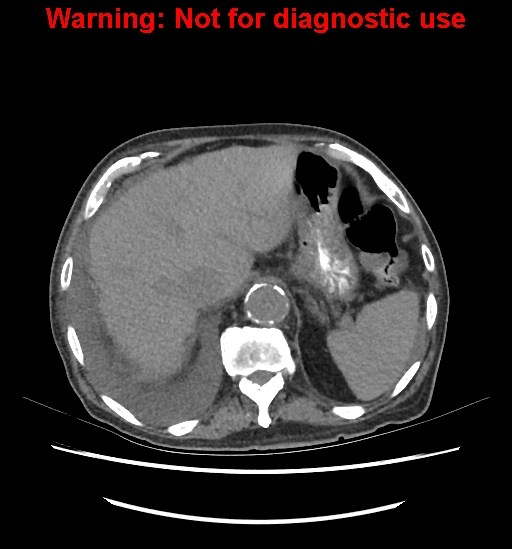 Aortic graft infection (Radiopaedia 44979-48907 Axial non-contrast 25).jpg