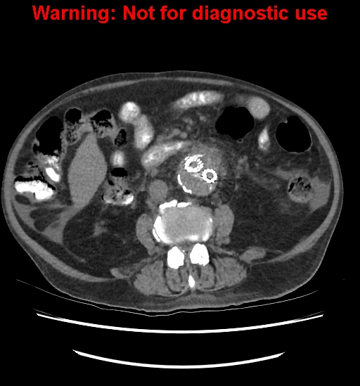 File:Aortic graft infection (Radiopaedia 44979-48907 Axial non-contrast 53).jpg