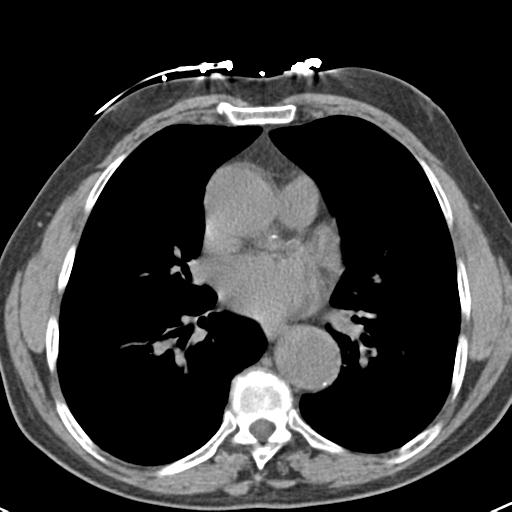 Aortic intramural hematoma (Radiopaedia 31139-31838 Axial non-contrast 31).jpg