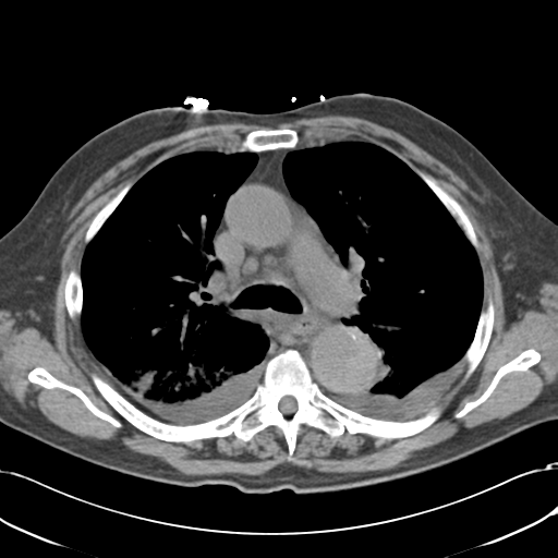 Aortic intramural hematoma (Radiopaedia 34260-35540 Axial non-contrast 25).png