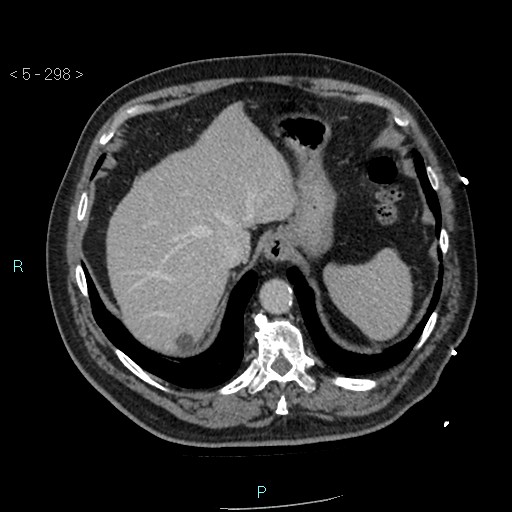 Aortic intramural hematoma (Radiopaedia 48463-53380 C 134).jpg