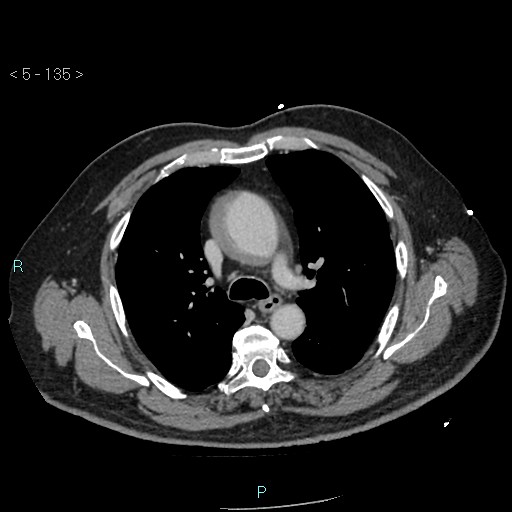 File:Aortic intramural hematoma (Radiopaedia 48463-53380 C 61).jpg