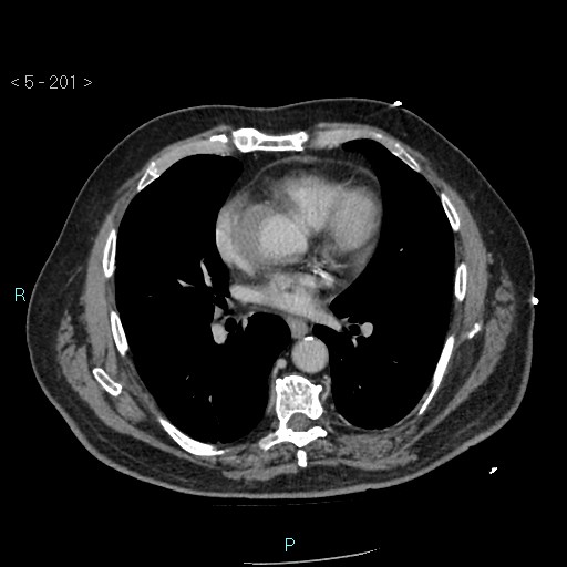 Aortic intramural hematoma (Radiopaedia 48463-53380 C 91).jpg