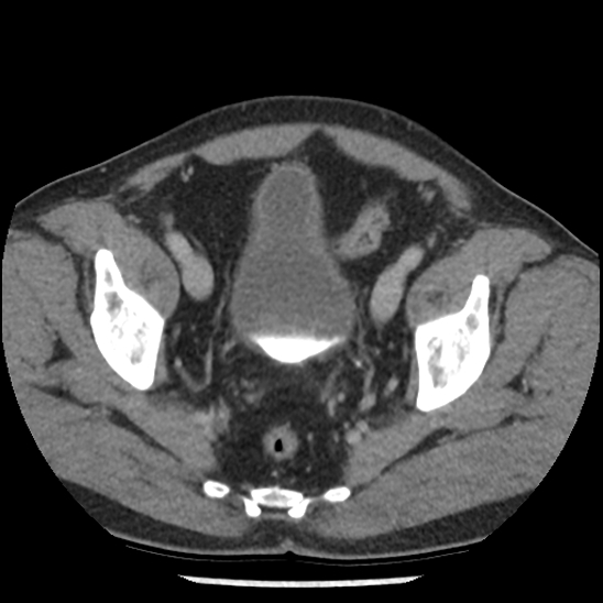 Aortic intramural hematoma (type B) (Radiopaedia 79323-92387 Axial C+ delayed 104).jpg