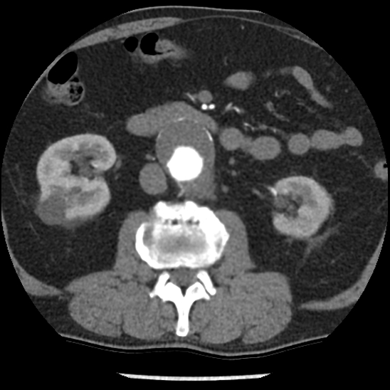 Aortic intramural hematoma (type B) (Radiopaedia 79323-92387 B 72).jpg