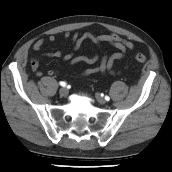 Aortic intramural hematoma (type B) (Radiopaedia 79323-92387 B 95).jpg
