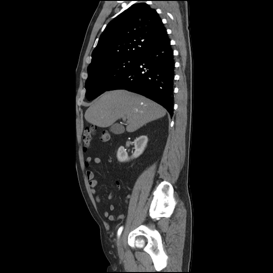 Aortic intramural hematoma (type B) (Radiopaedia 79323-92387 H 12).jpg