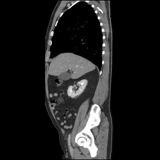 Aortic intramural hematoma (type B) (Radiopaedia 79323-92387 Sagittal C+ delayed 11).jpg