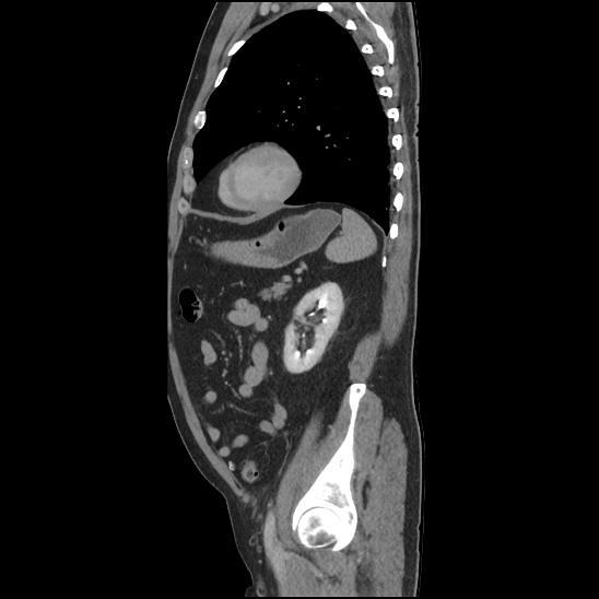 Aortic intramural hematoma (type B) (Radiopaedia 79323-92387 Sagittal C+ delayed 41).jpg